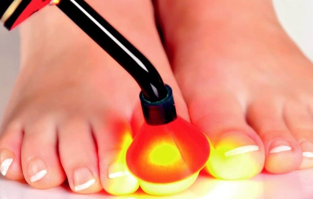 Laserbehandlung der Nagelplatte