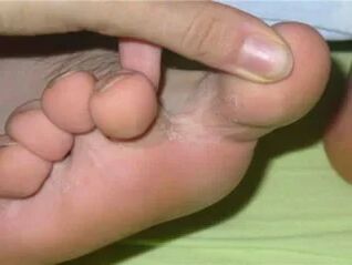 Juckreiz der Finger der Füße