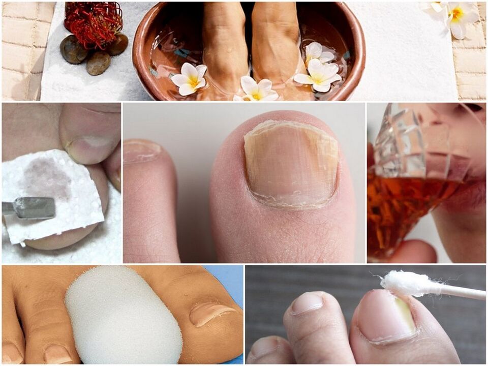 Behandlung von Nagelpilzen